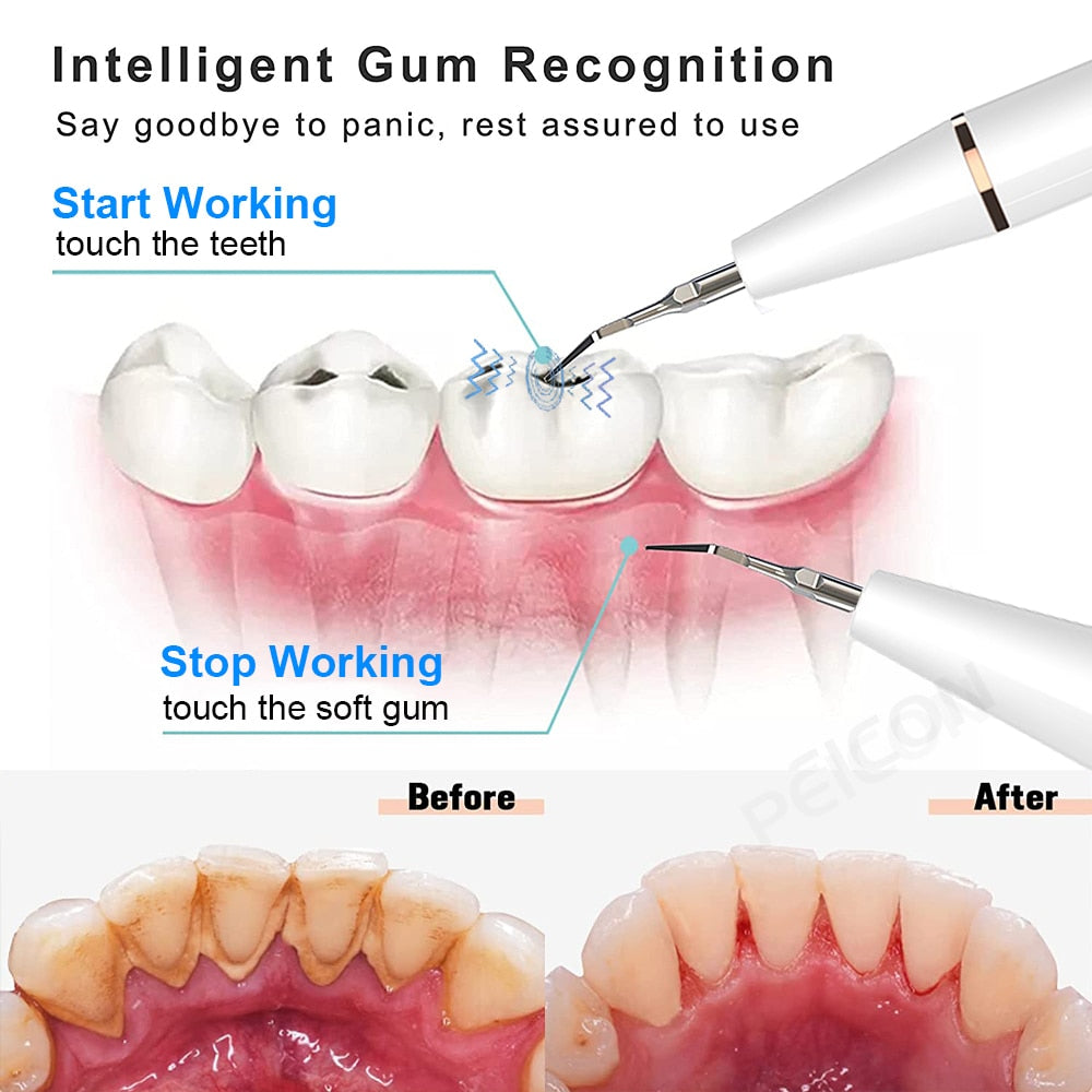 Escalador Dental ultrasónico para dientes, eliminador de cálculo Dental sónico, limpiador de placa Dental sónico, eliminación de piedra Denta