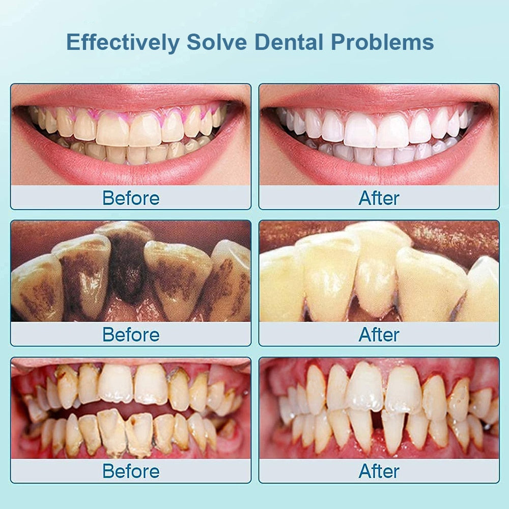 Escalador Dental ultrasónico para dientes, eliminador de cálculo Dental sónico, limpiador de placa Dental sónico, eliminación de piedra Denta